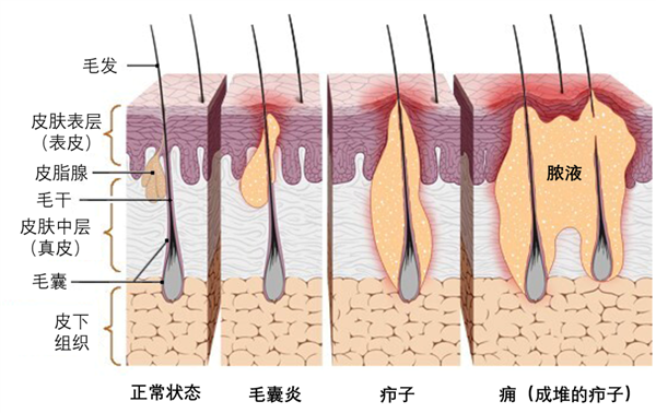 一種“紅包”又痛又腫：硬擠還很危險(xiǎn)